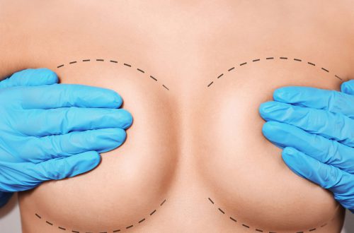 Mitos y verdades sobre la mamoplastia de aumento